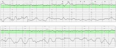 Case report: Emergency presentation of Meckel's diverticulum in the 3rd trimester of pregnancy